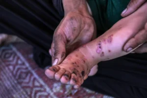 UN warns skin infections have tripled in Gaza displacement sites, impacting 10,000 people amid worsening shelter crisis.