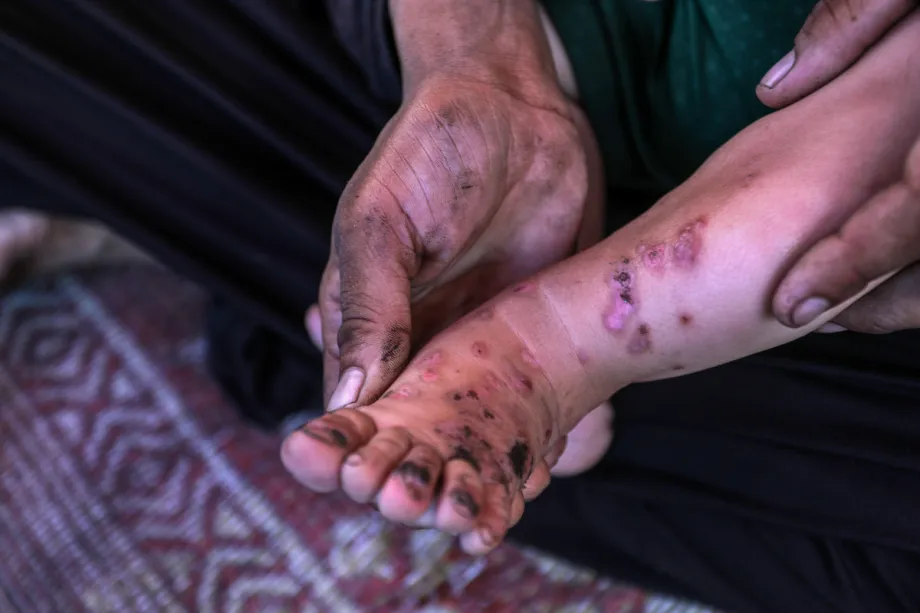 UN warns skin infections have tripled in Gaza displacement sites, impacting 10,000 people amid worsening shelter crisis.